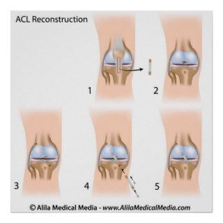 ACL reconstruction surgery diagram. Posters