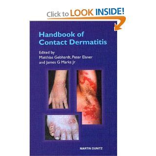 Handbook of Contact Dermatitis (9781841842271) Matthias Gebhardt, Peter Elsner, James G. Marks Books